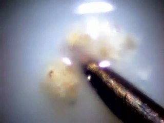 milk breaking up "morgellons" skin extractions