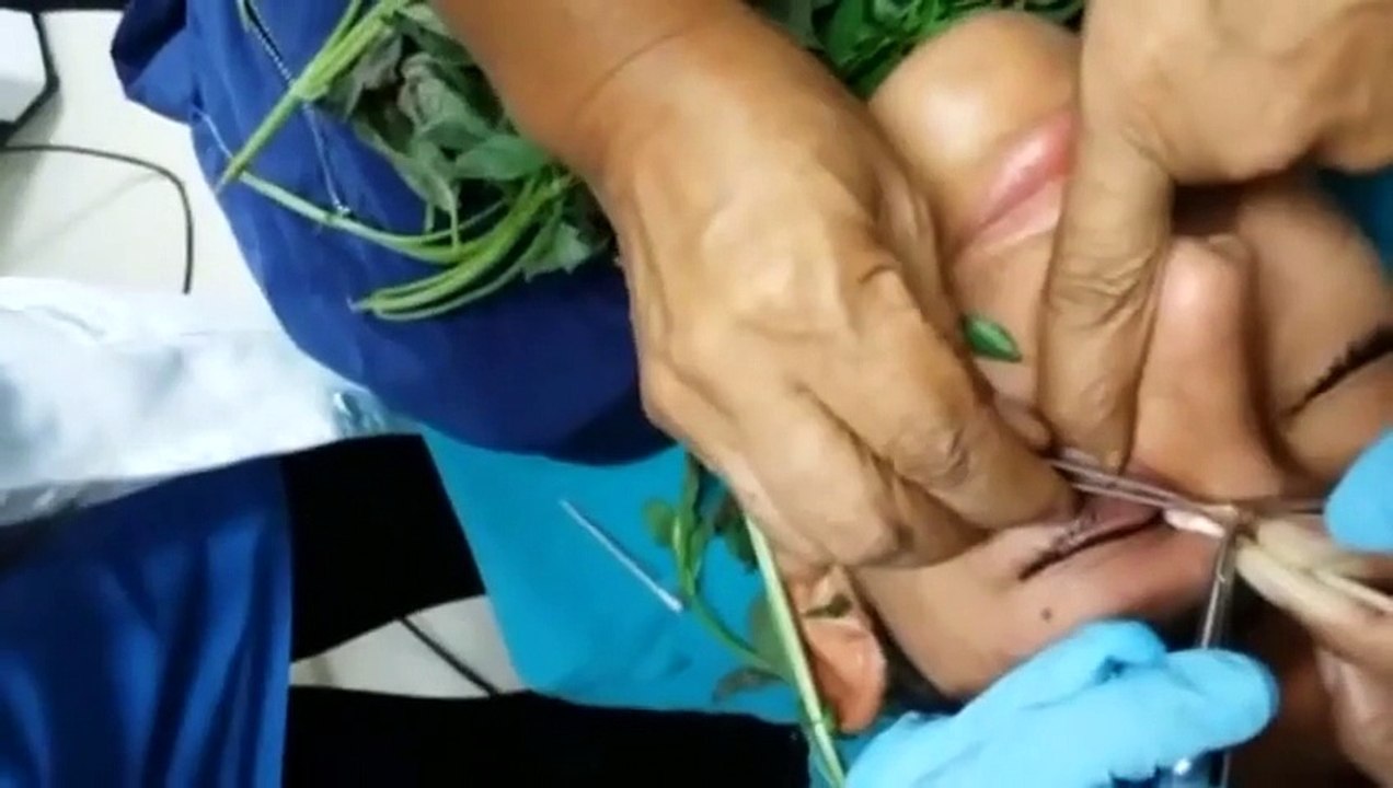 Doctors in Peru use basil to lure worm out of boys eye