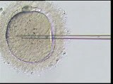 about infertility and ivf threatments icsi video.flv http://www.turkey-ivf.com