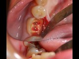 Dental  composite restoration