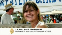 Chimp attack victim receives face transplant