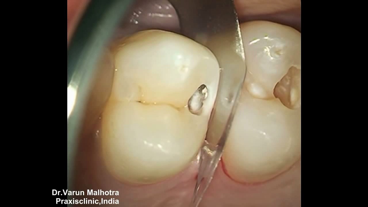 Conservative Tooth Cavity Preparation and Filling under Dental Operating Microscope