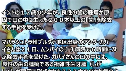 【閲覧注意】インドの少年から232本の歯を摘出