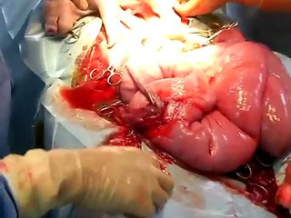 Cesarean birth of transgenic clone pig in TG lab of ATIT Taiwan(20080430)
