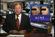 Los Angeles Dermatologist Gene Rubinstein, M.D. discusses Acne and Acne Scarring on PBS