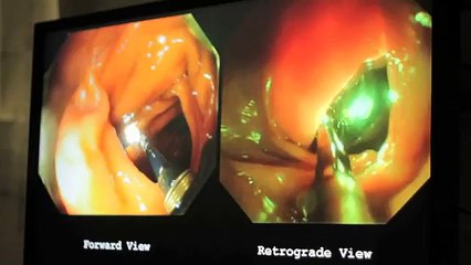 Colonoscopy Procedure