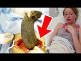 Girl Lived With A Giant HairBall In Her Stomach