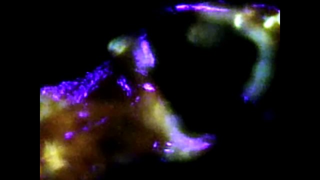MHS 22: Morgellons Skin Specimen Under Ultraviolet Light-Worms!