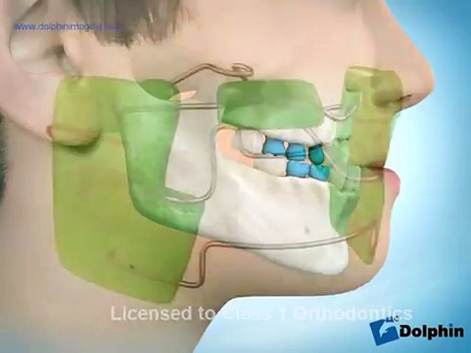 Frankel III  Class 1 Orthodontics