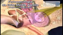 Otite Média Aguda - Fisiopatologia - O que é e como acontece - Clínica ORL Cóser