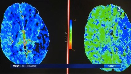 09/06/15 : France 3 Aquitaine / Nouvelle technique d'intervention sur les AVC