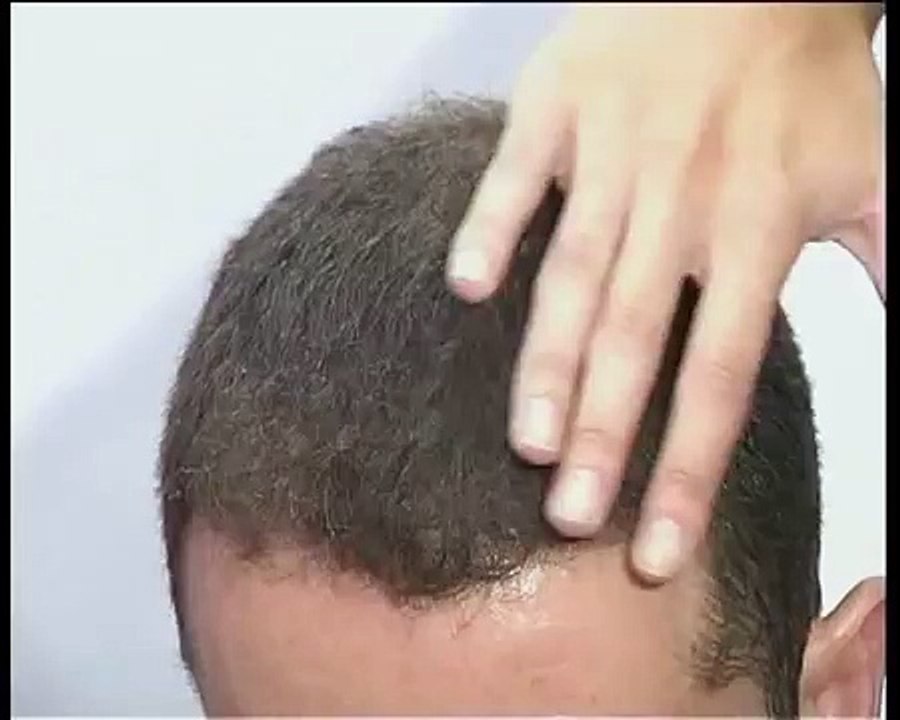 Densificador Capilar Natural: Fibras capilares keratina para disimular alopecia