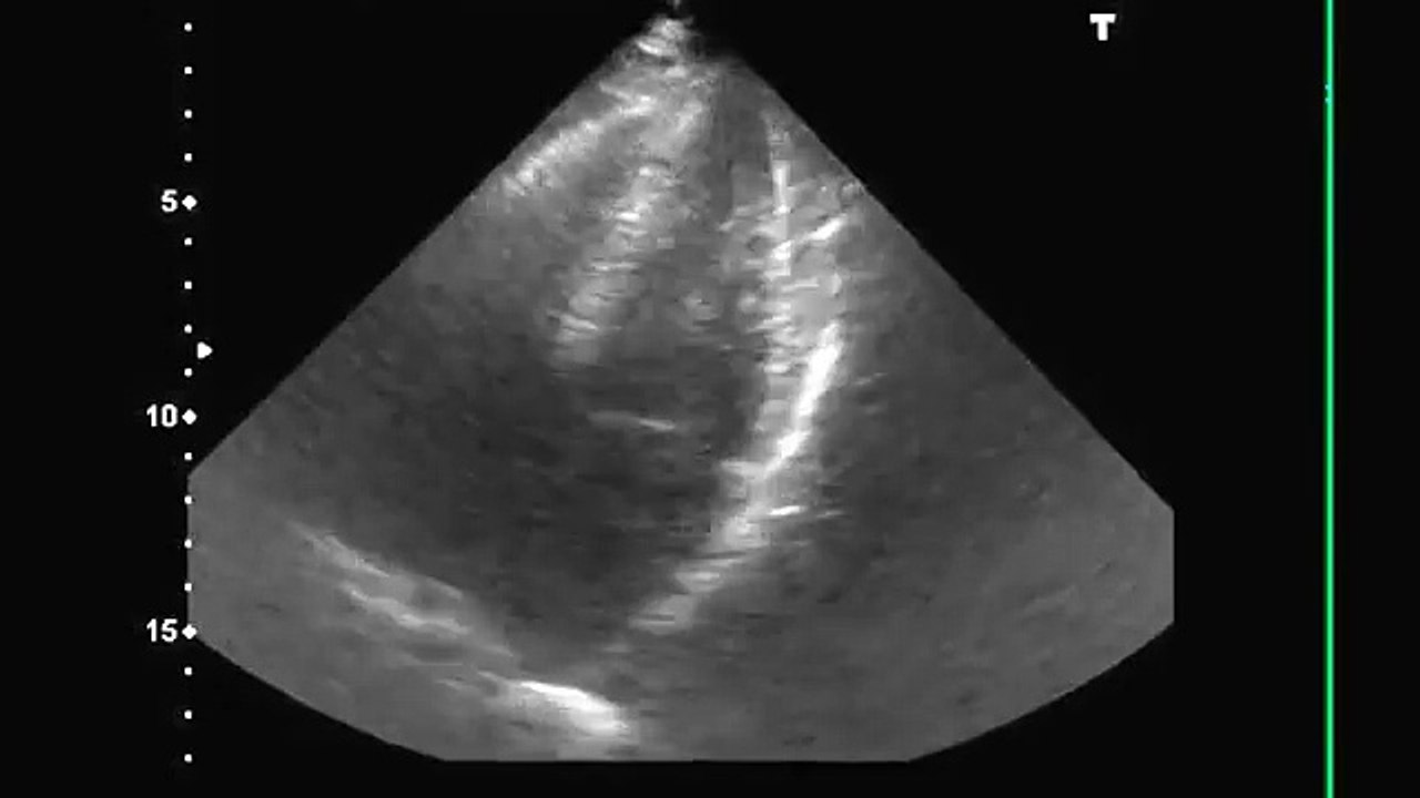 Fibrillation Auriculaire (FA) en échographie - Atrial Fibrillation (AF) ultrasound