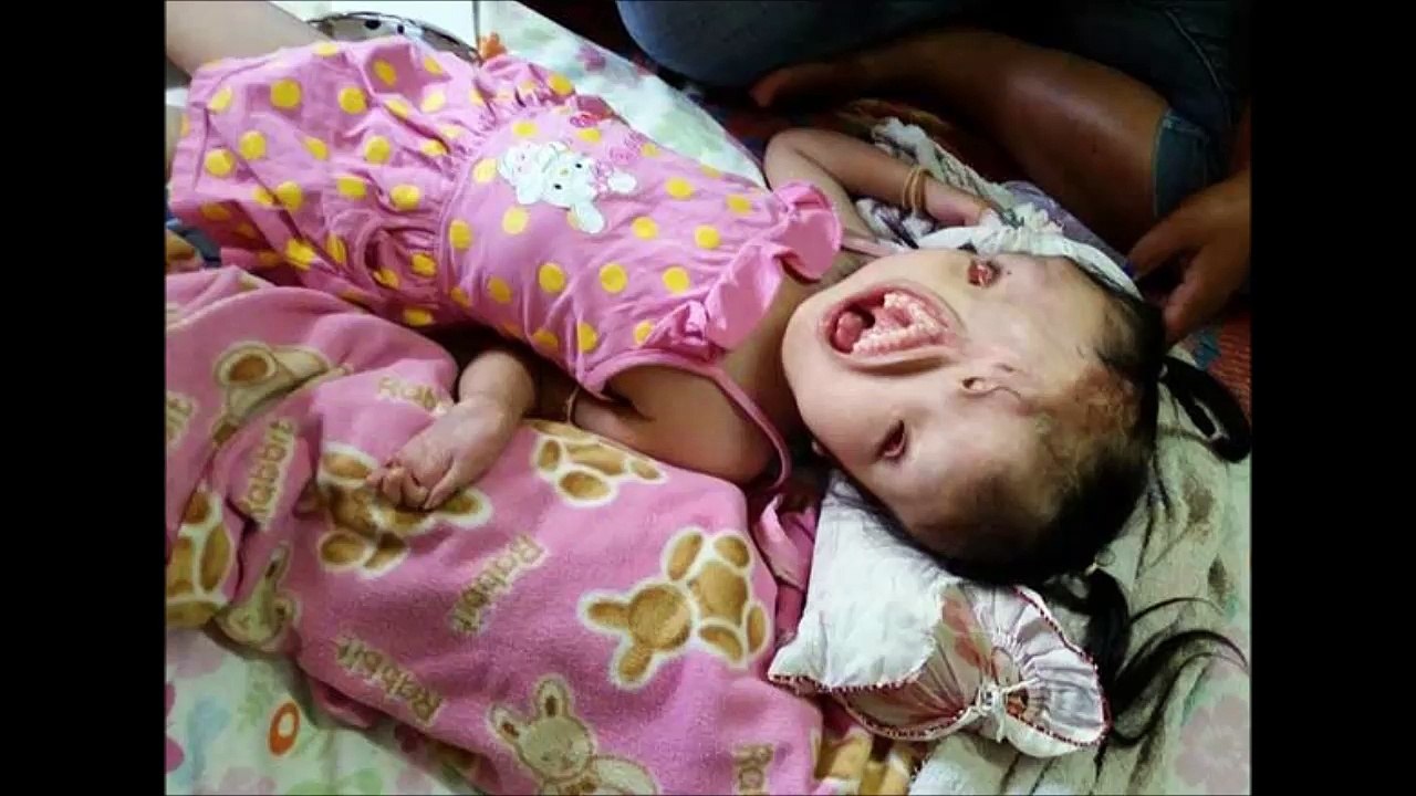 【閲覧注意】タイで難病や奇病の人達を支援しているBhinさんが神すぎる。