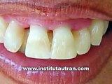 Estética dental: malposición superior (problema y solución)
