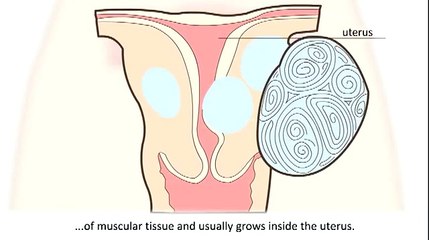 Uterine Fibroid (Fibroid in Uterus)  : How To Know If You Have a Fibroid and Treatment Options