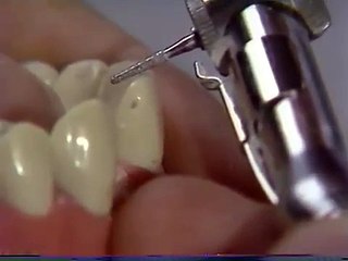 PFM Metal Ceramic Crown Prep - Central Incisor *Winged