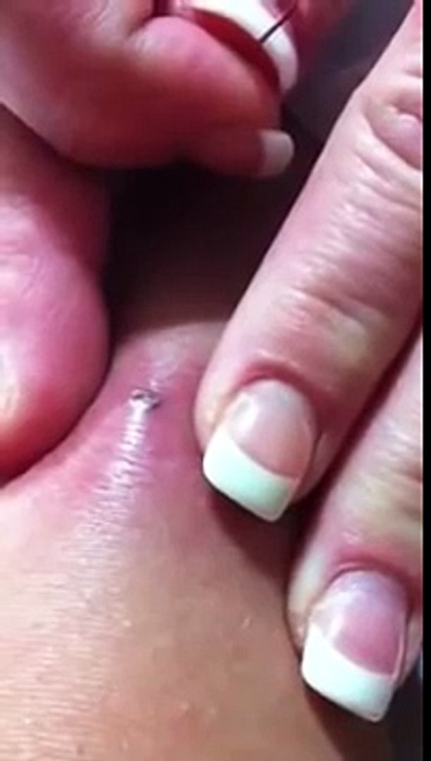 Big Zit Pop Video Dailymotion