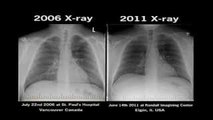 Chest X-Ray Electronic Cigarettes Before and After Smoking Health harmful