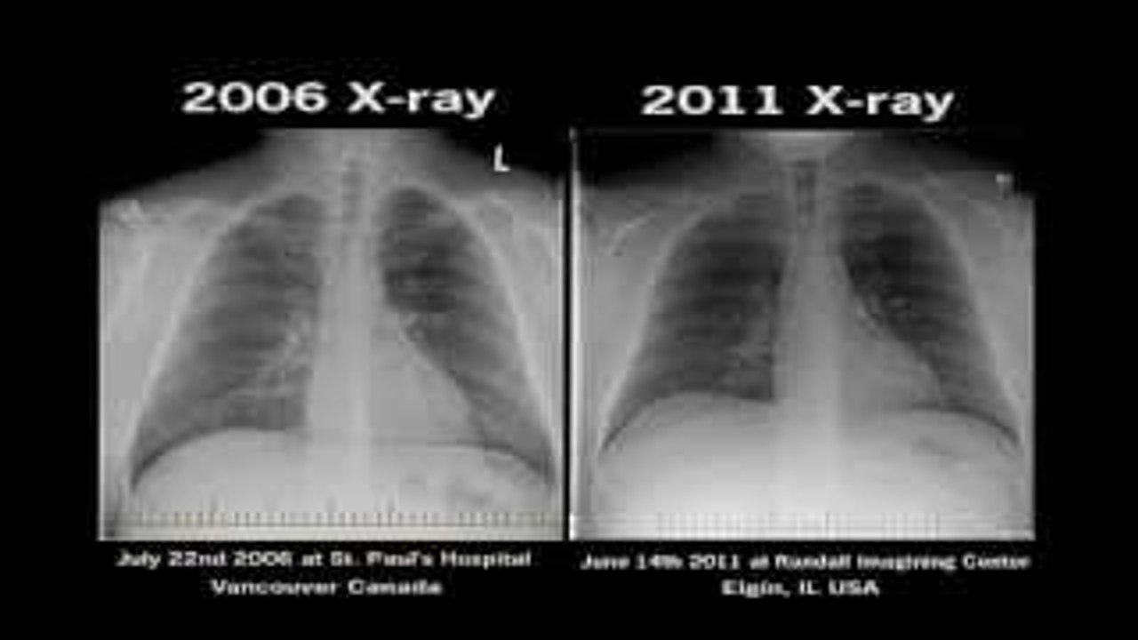 Chest X-Ray Electronic Cigarettes Before and After Smoking Health harmful