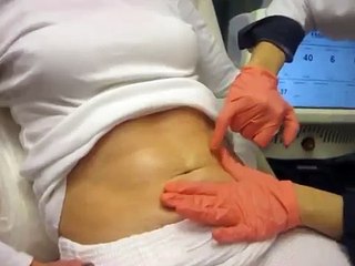 Fraxel Treatment for Reduction of Stretch Marks by BioDerma
