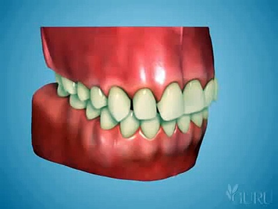 Orthodontie Invisalign