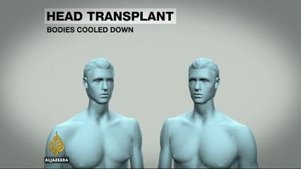 Neurosurgeon to attempt world's first head transplant
