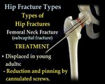 Hip Fractures, Types  and fixation - Everything You Need To Know - Dr. Nabil Ebraheim