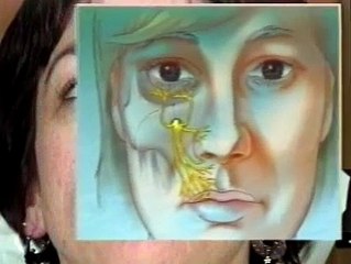 Maxillary Anesthesia   5 Infra Orbital Nerve Block