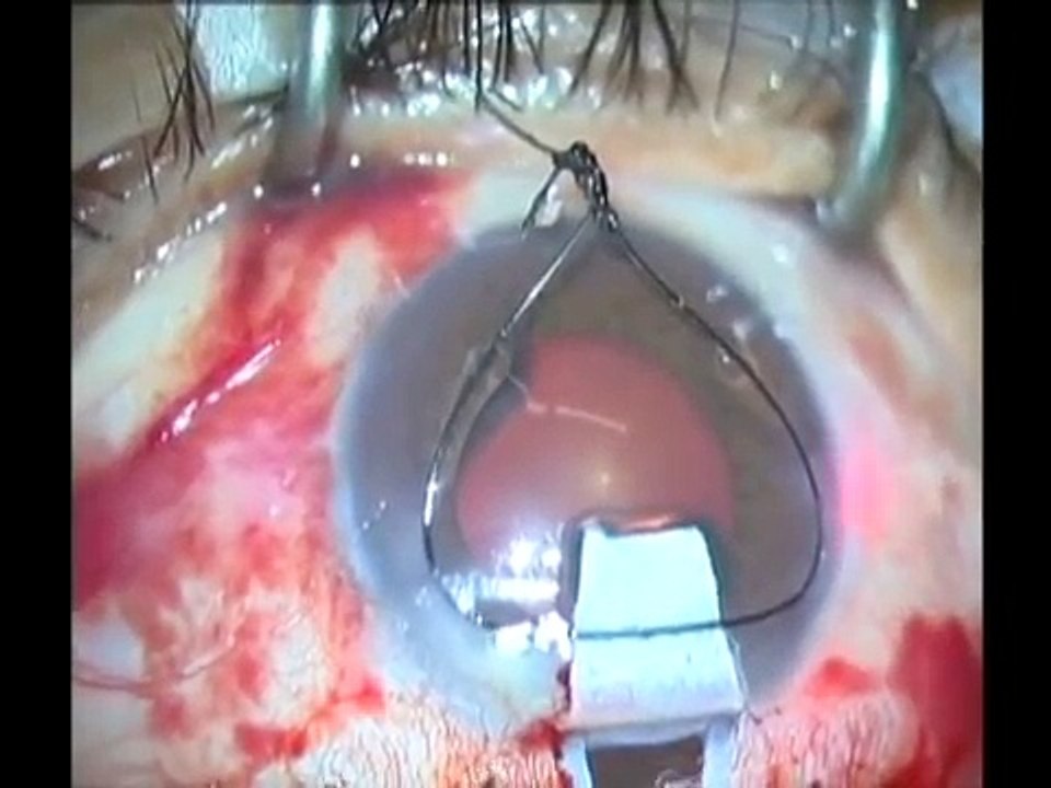 Advanced glaucoma surgery: Canaloplasty complications and solutions