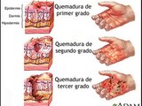 PREVENCIÓN QUEMADURAS