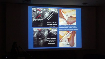 MRI and US of Peroneal Tendon Injuries - Mihra S. Taljanovic