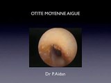 Otite Moyenne Aigue/ Acute otitis media