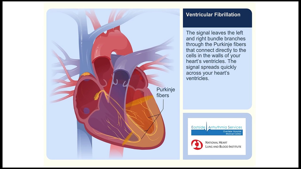 Ventricular Fibrillation Animation Video