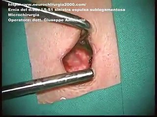 Ernia del disco L5-S1 sinistra. Microchirurgia