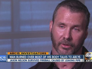 Gilbert man burned over most of his body talks to ABC15