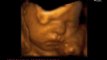 32 weeks 3D Ultrasound 4D Ultrasound
