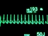 Supraventricular Tachycardia with Synchronized Cardioversion