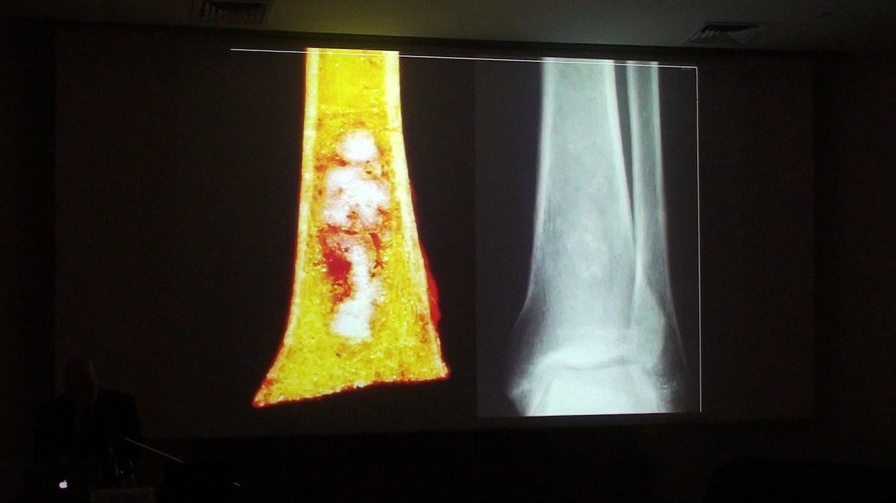 Incidential Osseous Lesions - Mark J. Kransdorf