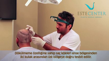 İbrahim ÇEVİK Anlatıyor "Donör Alanı Nasıl Tespit Edilir?"