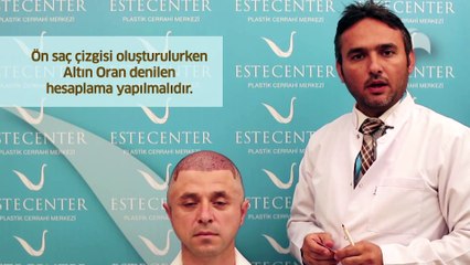 İbrahim ÇEVİK Anlatıyor "Erkeklerde Ön Saç Çizgisi Nasıl Tespit Edilir?"