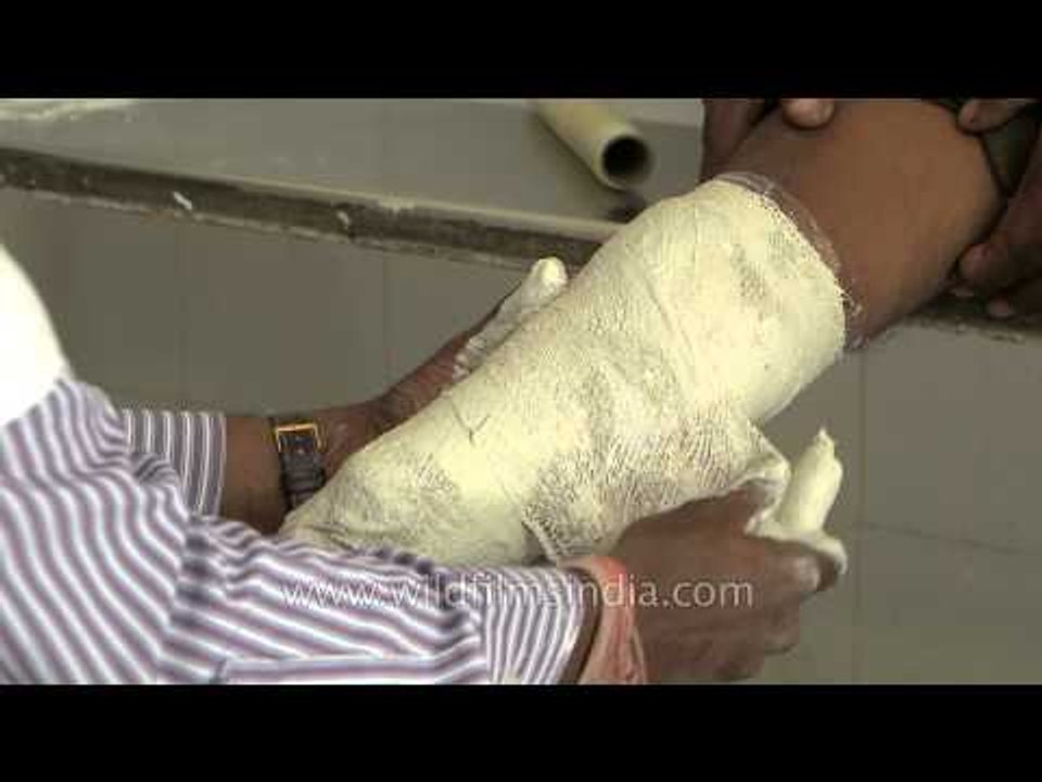 Measurement done for equipping with artificial limb