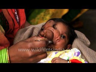 Baby girl born with a trunk worship as Lord Ganesha