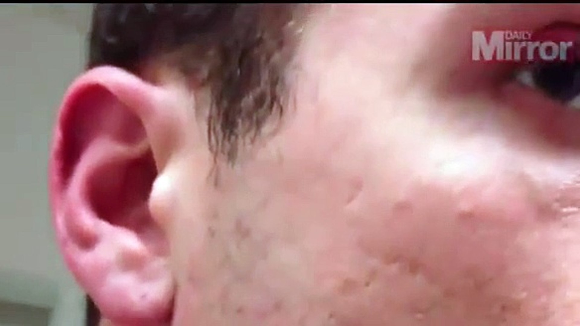 Is This The Longest Ingrown Hair In History Man Films Himself