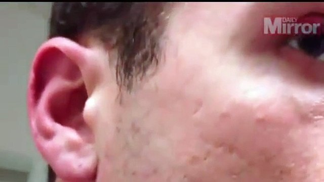 Is this the longest ingrown hair in history? Man films himself removing pus-covered black strand