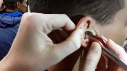 Un énorme bouchon de cérumen dans l'oreille