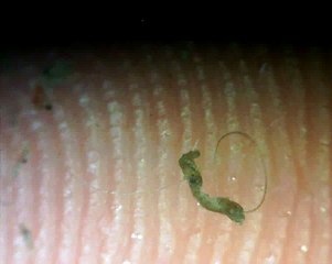 the cause of morgellons painful bites