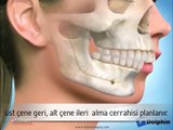 Üst Çenenin Geriye, Alt Çenenin İleri Alınması - Ortodontist