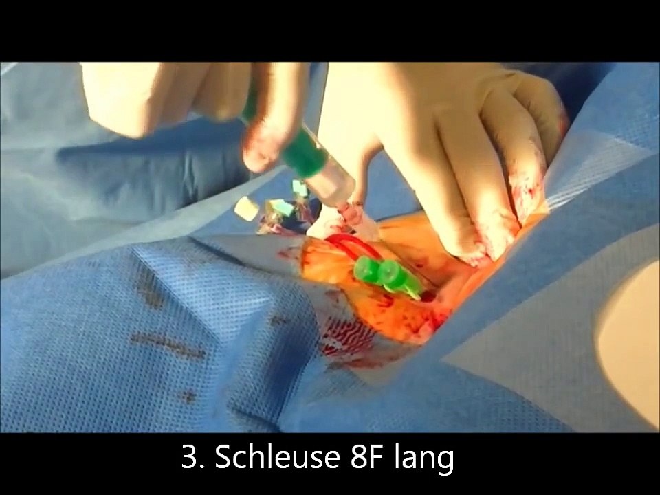 EPU - Ablation Vorhofflattern