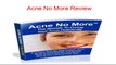 Acne No More Review [SHOCKING] - My Real and Honest Acne No More Review! -  Acne No More Discount